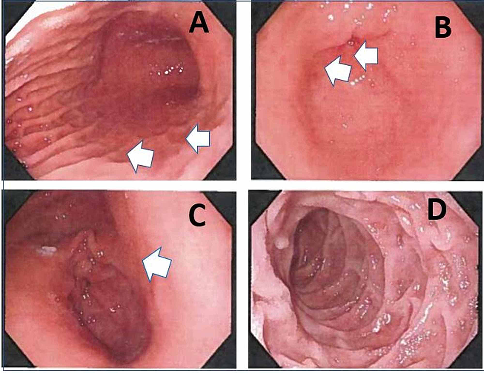 throat hurts smoking cigarettes Effects of Smoking on Your Throat and How to Quit for Good