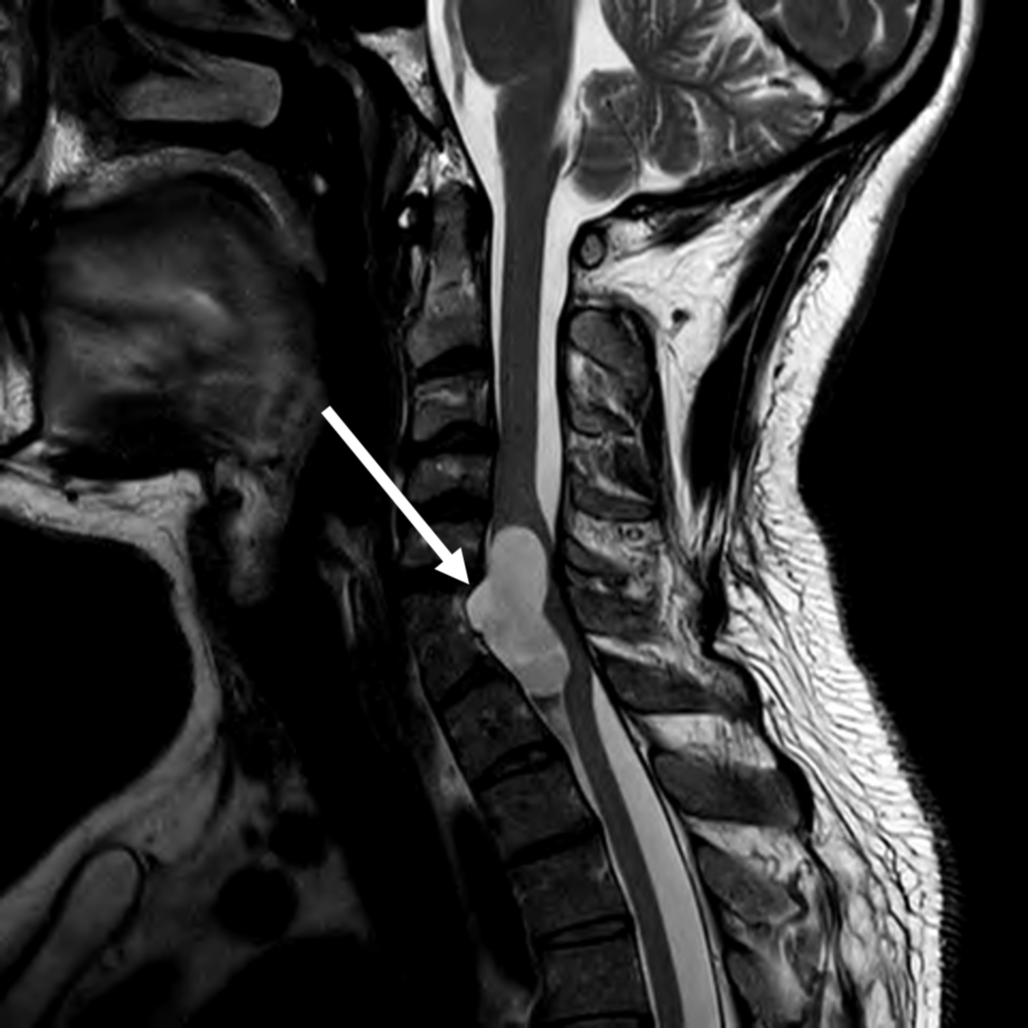 Cureus Neurenteric Cyst Case Report And Operative Video