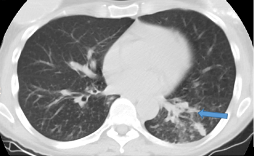 Cureus | A Case of Isolated Pulmonary Mycobacterium Avium Complex Being the First Presentation ...