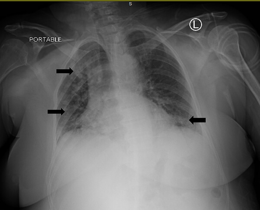 Chest-X-ray-reveals-bilateral-infiltration