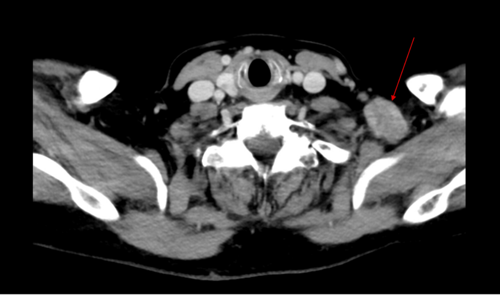 Dormancy Leading to Late Recurrence in Breast Cancer