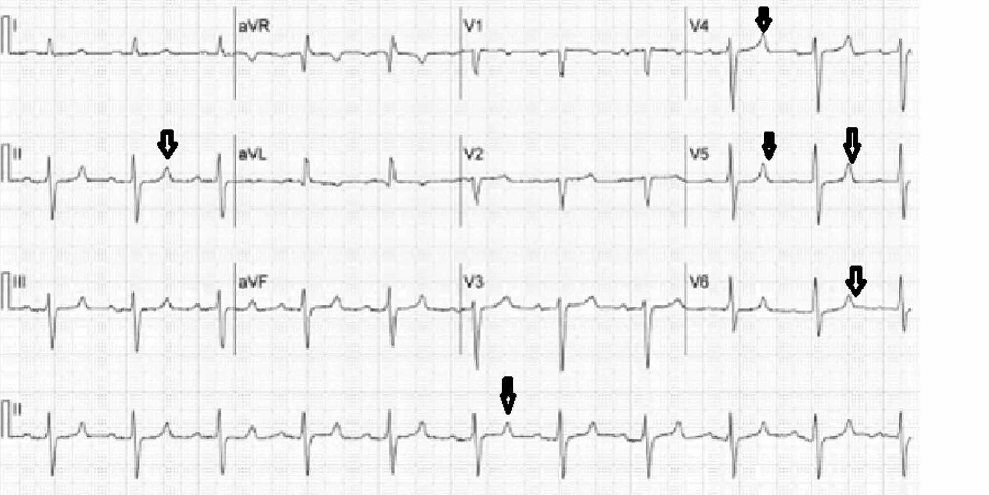 Cureus | Cocaine and Alcohol Co-Ingestion-Induced Severe Rhabdomyolysis ...