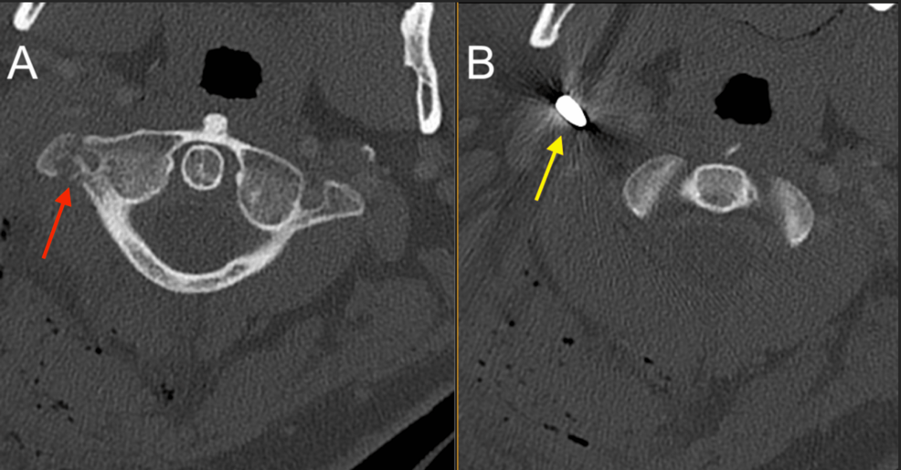 A-CT-scan-of-the-cervical-spine.