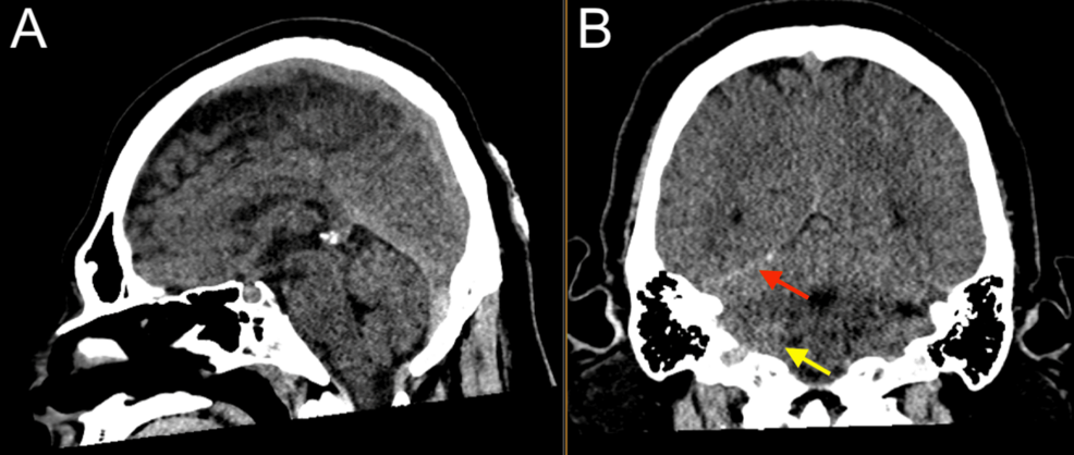 Head-CT-showing-trace-right-posterior-fossa-and-tentorial-leaflet-subdural-hemorrhage-(red),-and-trace-right-cerebellar-subarachnoid-hemorrhage-(yellow).