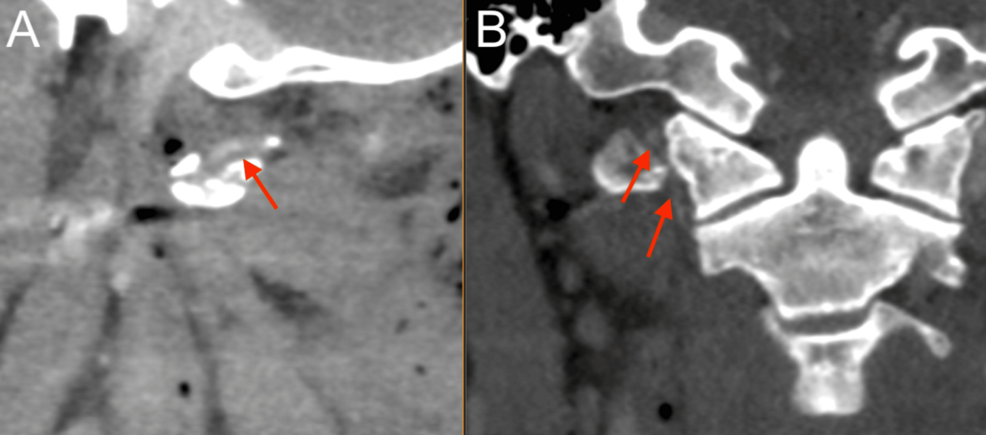 Neck-CTA-showing-Biffl-Grade-2-injury-to-right-vertebral-artery-at-level-of-C1-C2-(red).