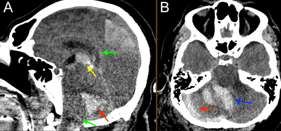 Head-CT-showing-right-cerebellar-parenchymal-hemorrhage-(red),-third-ventricle-intraventricular-hemorrhage-(yellow),-fourth-ventricle-intraventricular-hemorrhage-(blue),-foramen-magnum-crowding,-and-third-ventricle-upward-herniation-demonstrating-posterior-fossa-fullness-(green).