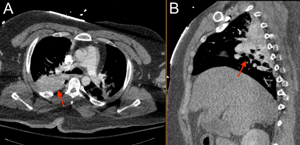 Chest-CTA-showing-possible-pulmonary-hemorrhage,-contusion,-and-atelectasis-(red).