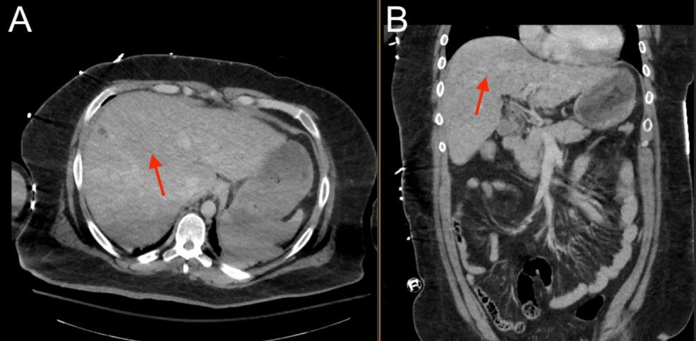 Abdominal-CT-showing-suspected-chronic-liver-disease-(red).