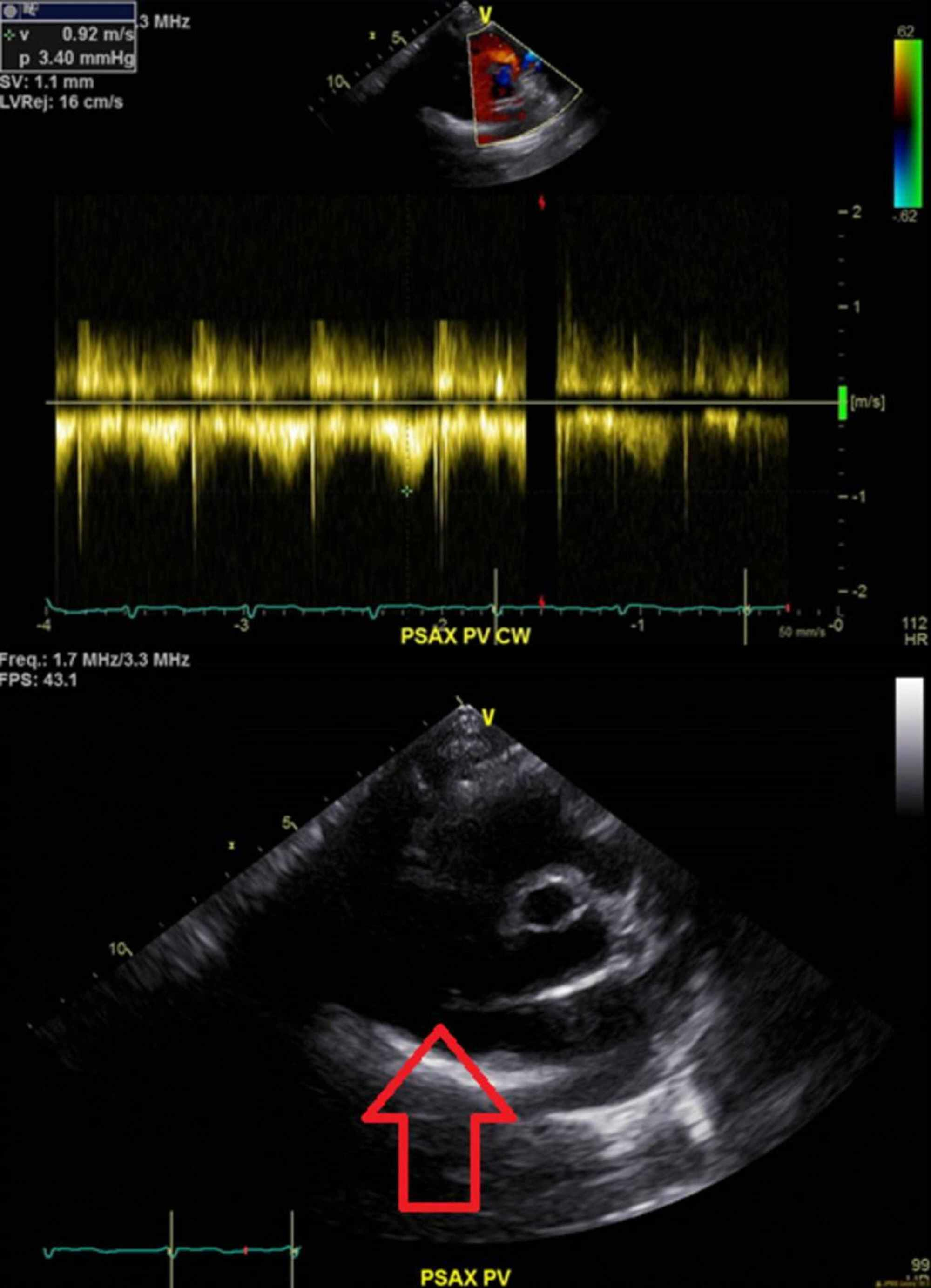 Cureus Isolated Pulmonary Valve Endocarditis