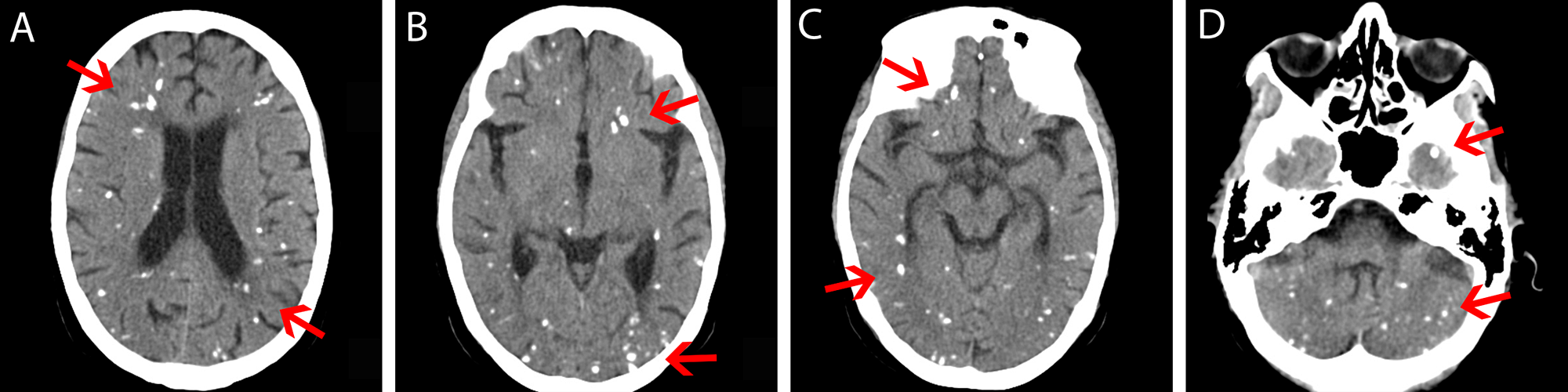 radiation induced mesothelioma