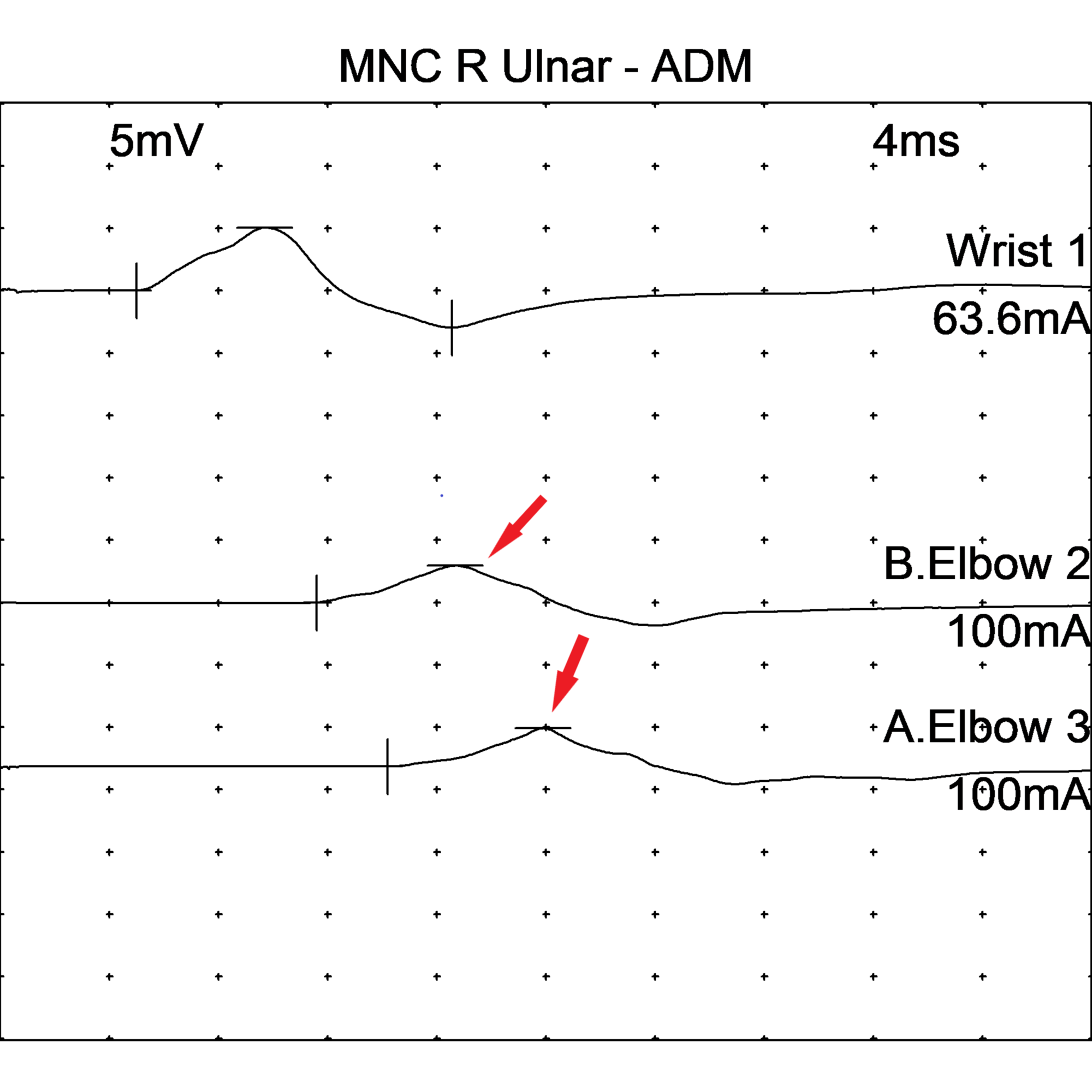 A Rare Case Of Charcot-marie-tooth Disease Type 1c With An Unusual 