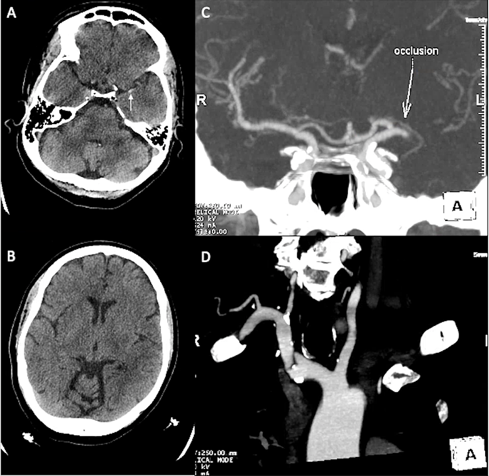 Cureus, Brainstem and Spinal Arachnoiditis Ossificans Associated With  Neurocysticercosis: A Case Report