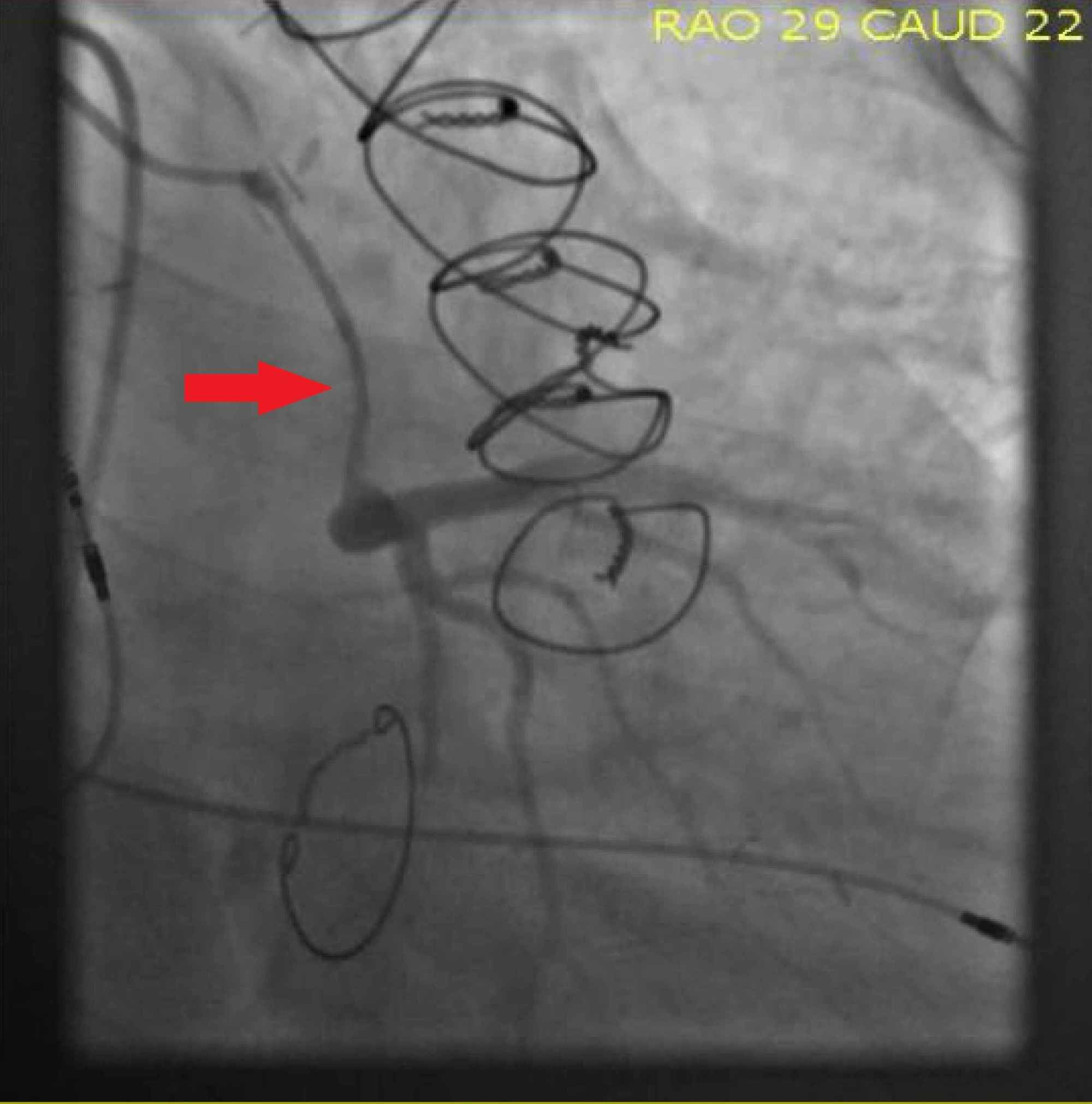 Download Cureus Protected Percutaneous Coronary Intervention Pci Of Cabrol Type Anastomosis Of Saphenous Vein Graft Svg To The Left Main Coronary Artery Lmca