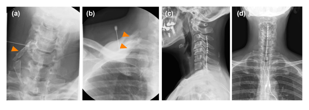 Peripheral-nerve-block-and-spinal-cord-stimulation.