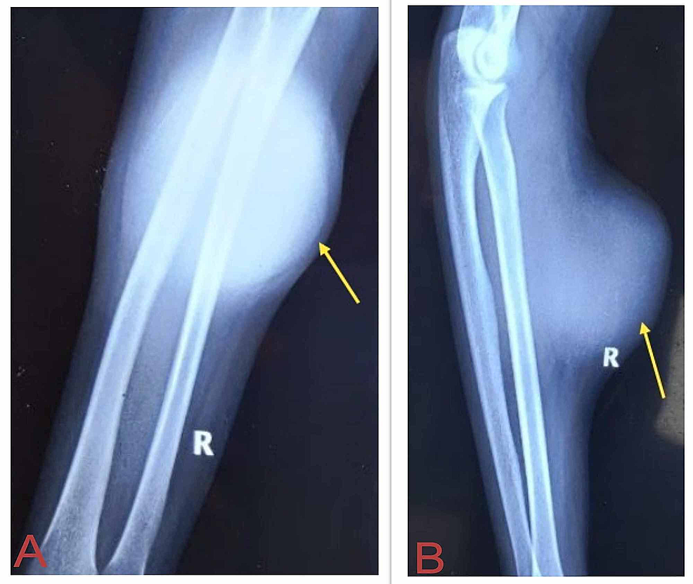 Preoperative-X-rays-of-the-right-forearm-showed-increased-soft-tissue-shadows-with-no-bony-involvement.