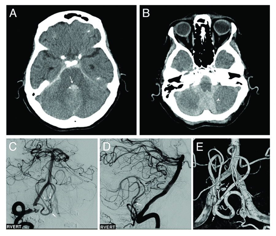 Cureus | Multiple Aneurysms on Inter-PICA Communicating Collaterals ...