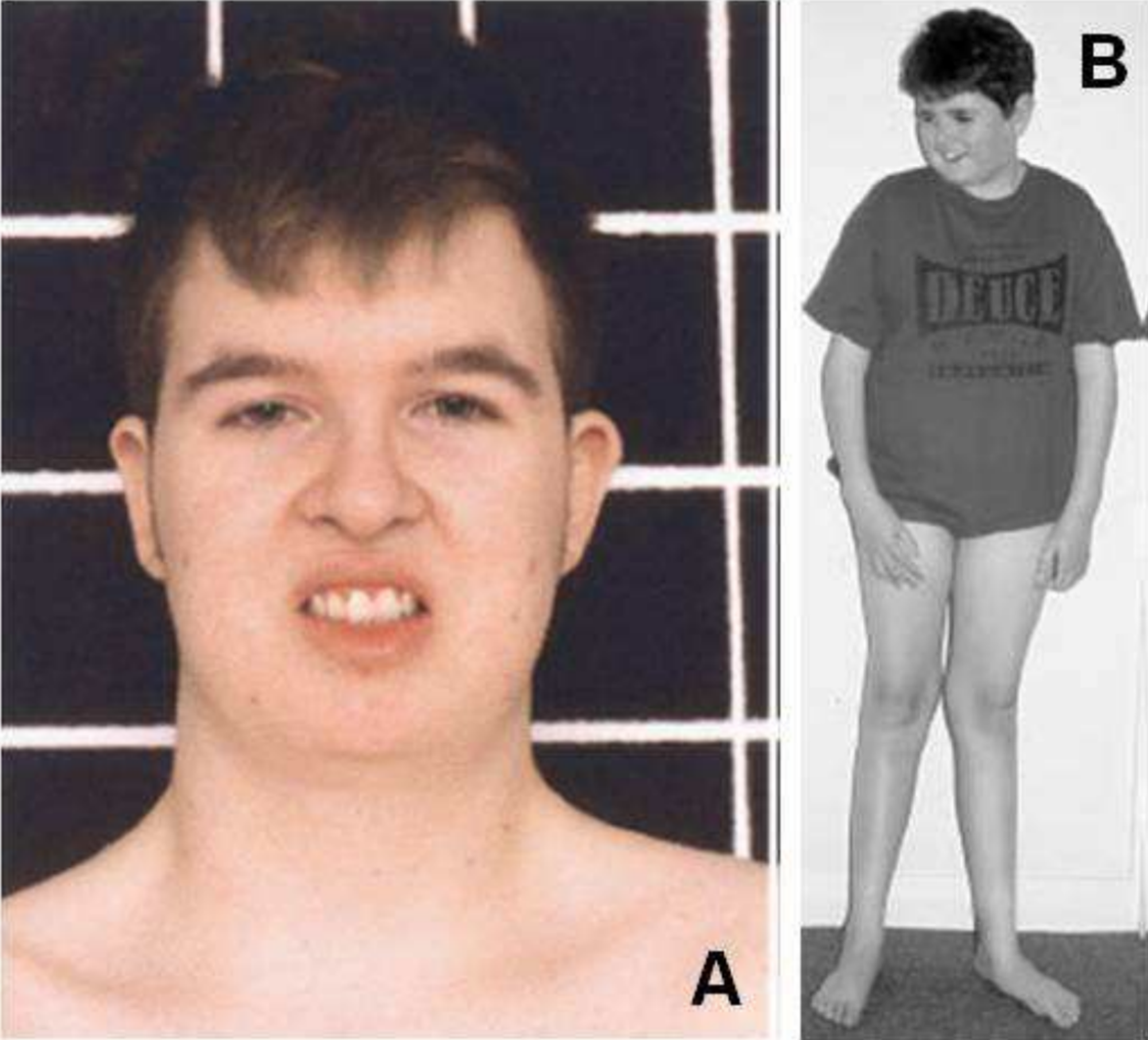 Cureus | Cystoid Macular Edema in a 10-Year-Old Boy With Cohen Syndrome