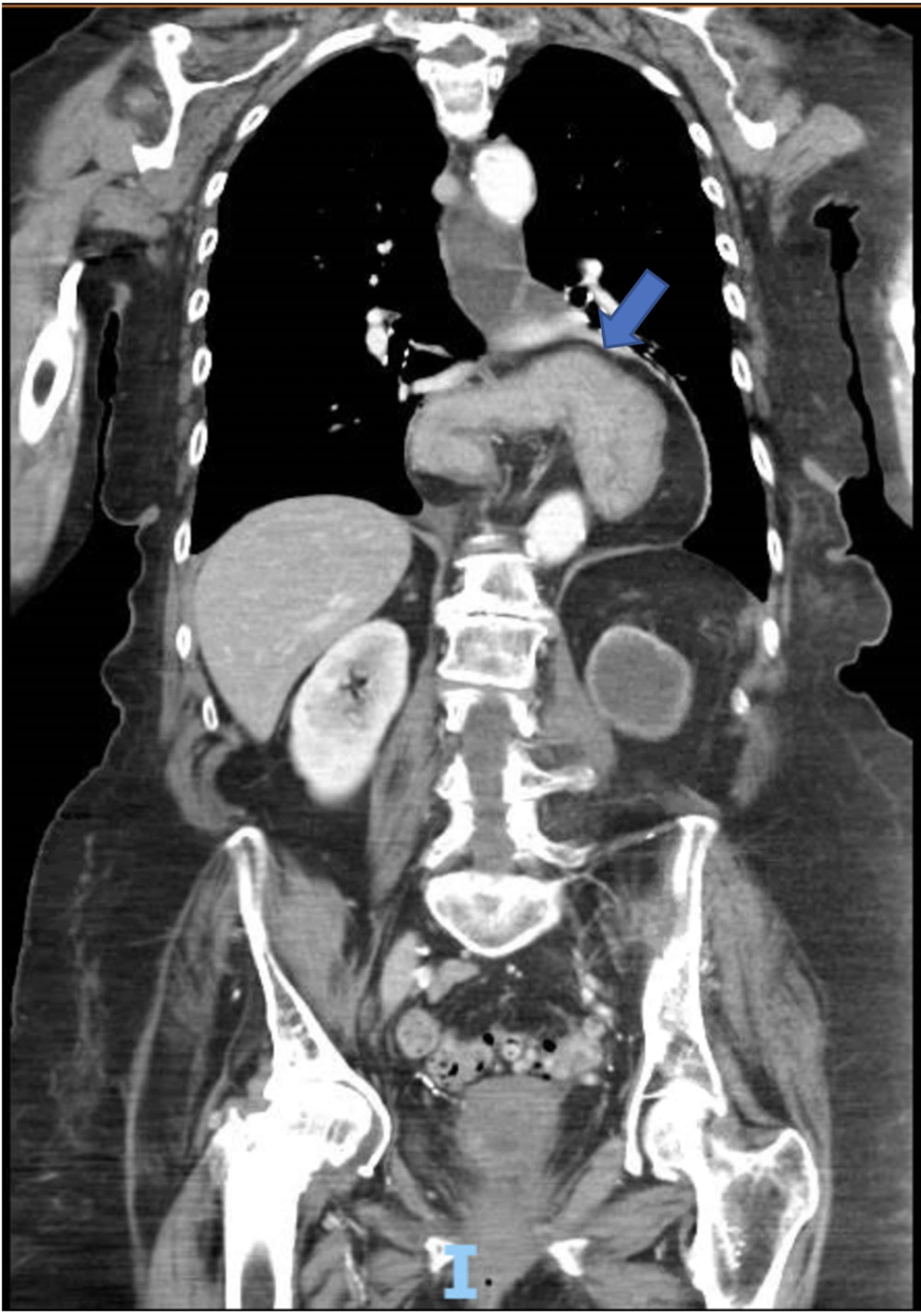 paraesophageal hernia with gastric volvulus