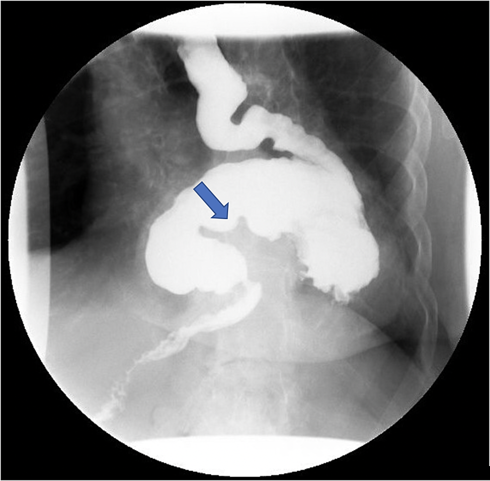 Cureus A Case of Intermittent OrganoAxial Gastric Volvulus