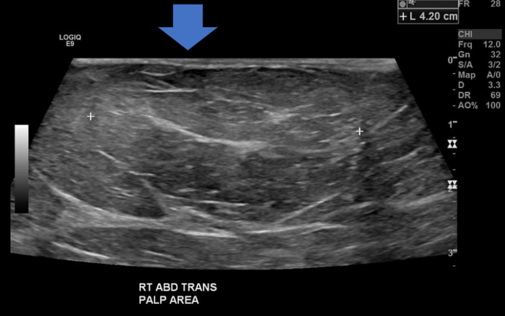 Cureus | Sixty-One-Year-Old Female With Metastatic Poorly