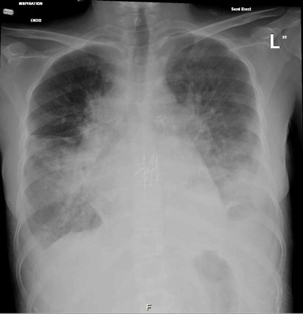 First Case of Brucella Pneumonia in a Lung Transplant Patient: Case ...