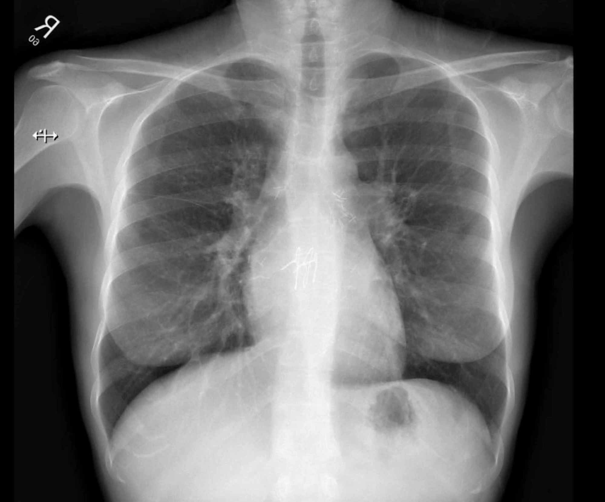 Cureus | First Case of Brucella Pneumonia in a Lung Transplant Patient ...