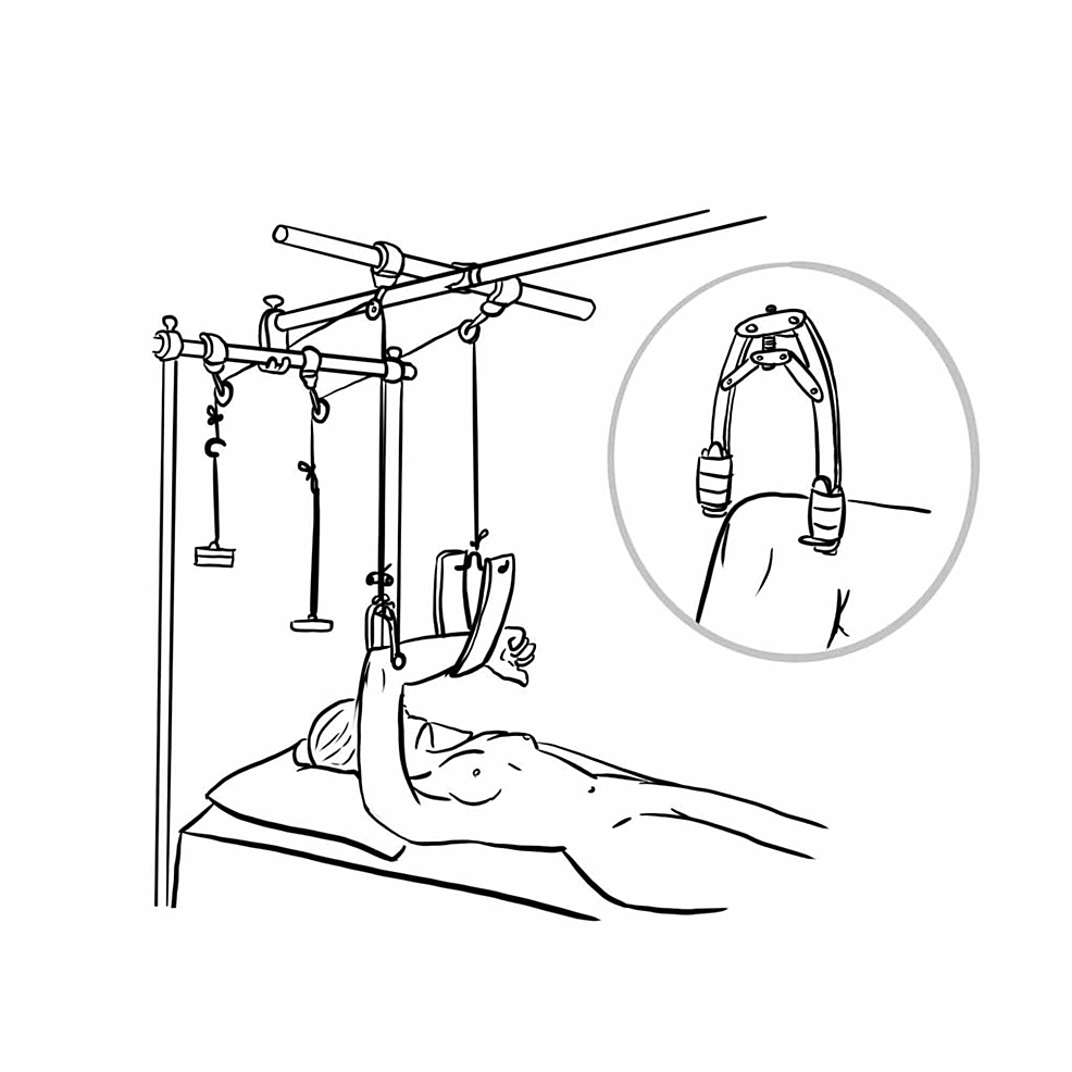 Cureus Keeping the Traction on in Orthopaedics