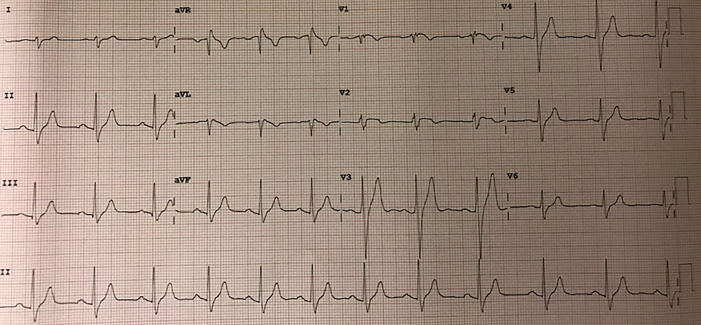 Cureus | Cannabinoid-Induced Brugada Syndrome: A Case Report