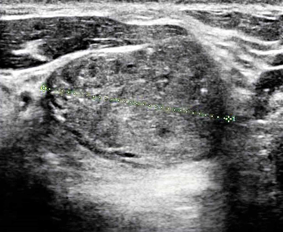 Cureus Clavicular Osteomyelitis Secondary To Candida Parapsilosis Infection 9865