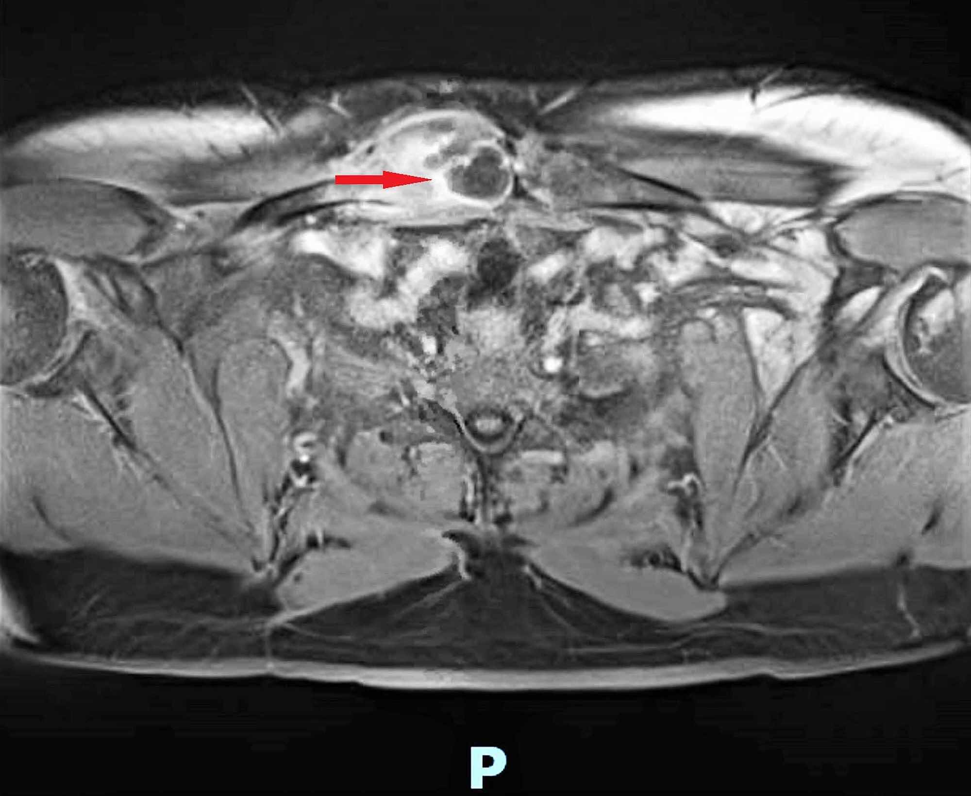 Cureus | Clavicular Osteomyelitis Secondary To Candida Parapsilosis ...