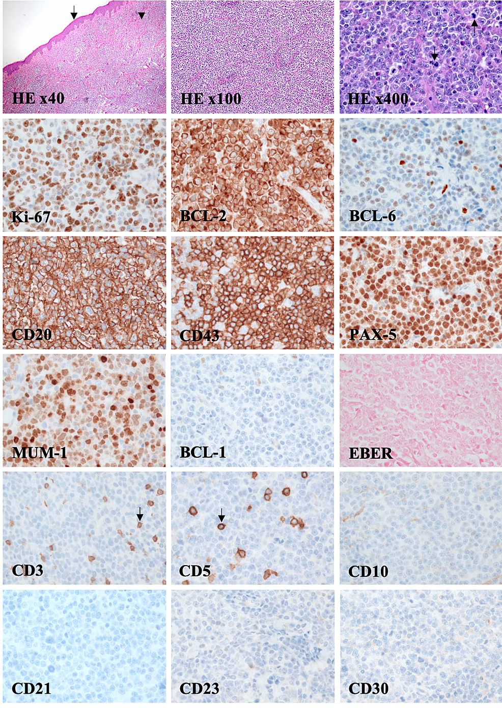 Primary Cutaneous Diffuse Large B-Cell Lymphoma, Leg Type: A Case ...