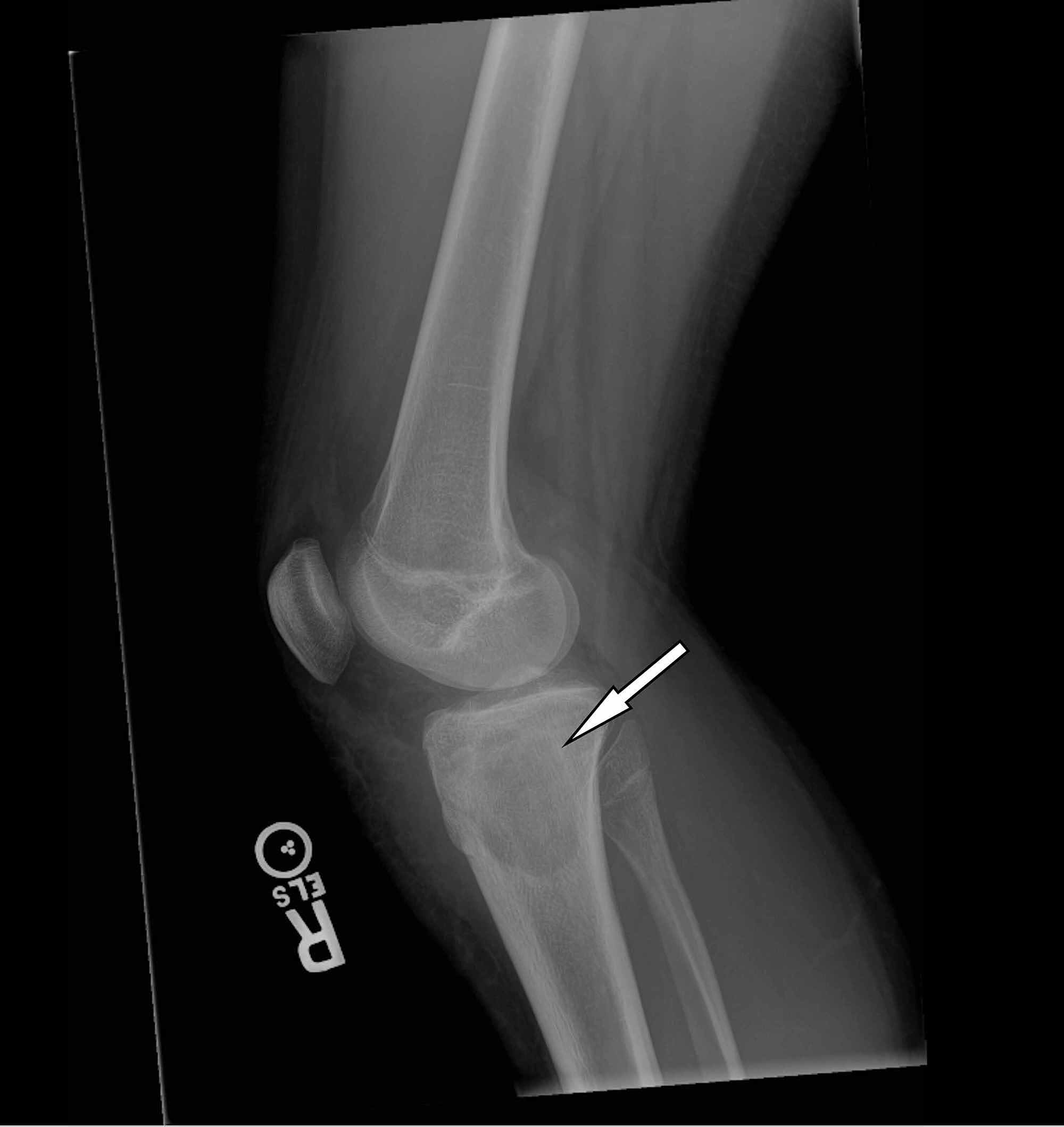 Cureus | A Case of Brodie’s Abscess With Tibial Erosion and ...