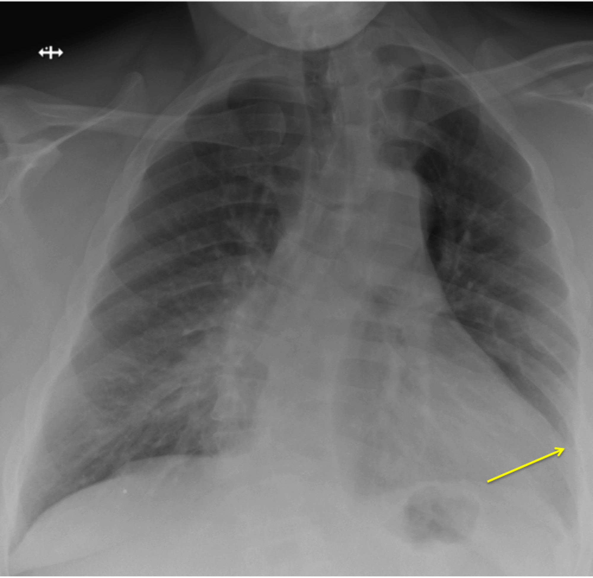 Cureus | Delayed Tracheostomy in a Patient With Prolonged Invasive ...