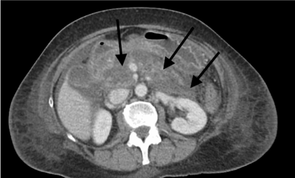 CT-imaging-confirming-acute-necrotizing-pancreatitis.