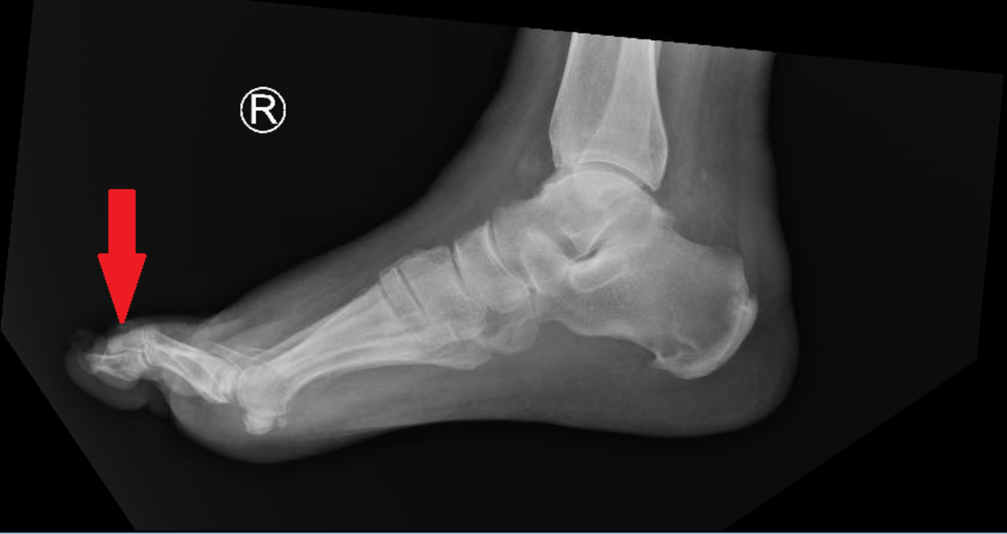 Cureus Acute Myeloid Leukemia A “Head to Toe” Examination