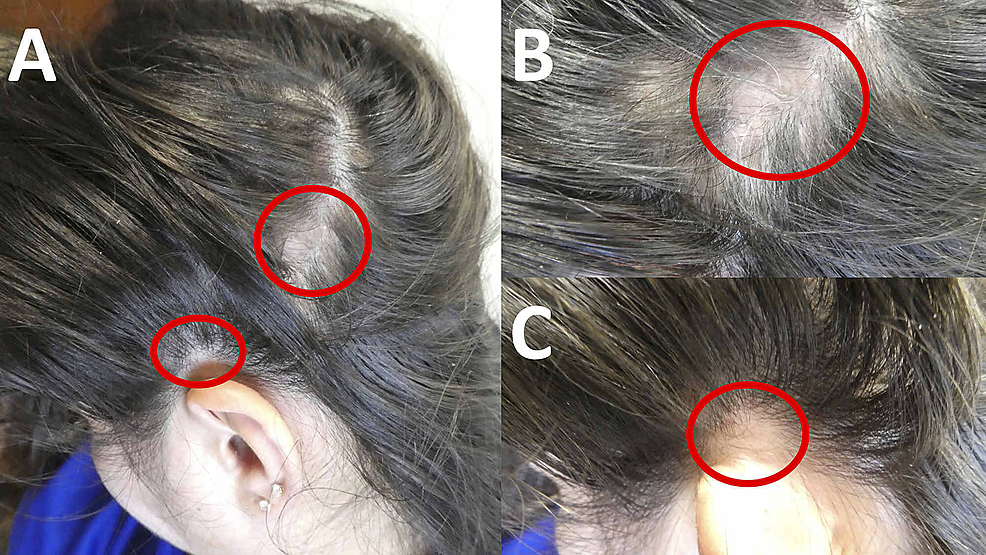 Cutaneous-presentation-of-alopecia-areata-of-the-left-temporal-scalp