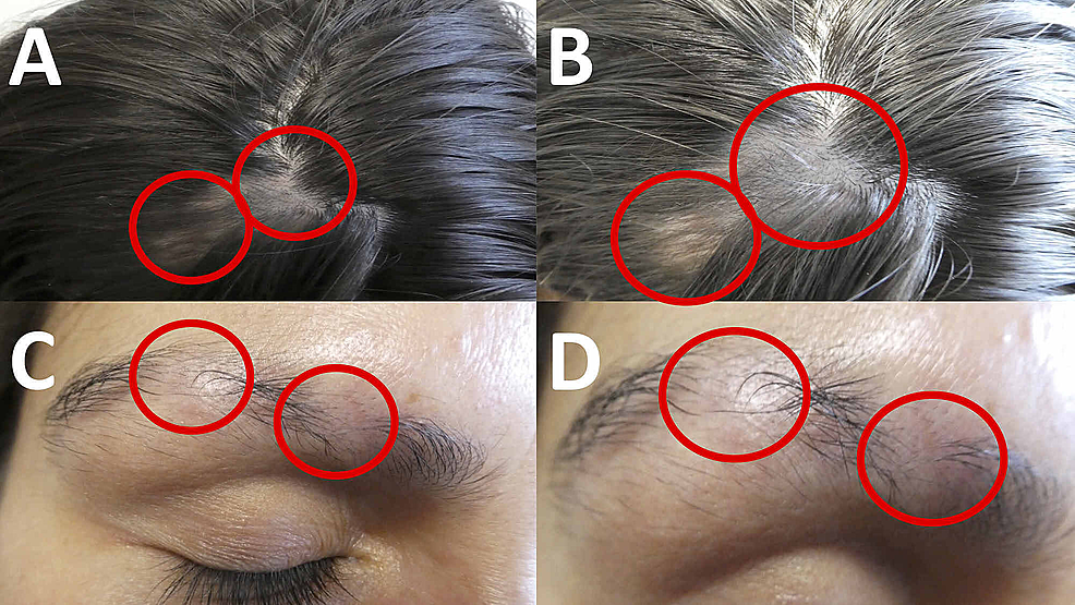 Cutaneous-presentation-of-alopecia-areata-of-the-frontal-scalp-and-right-eyebrow