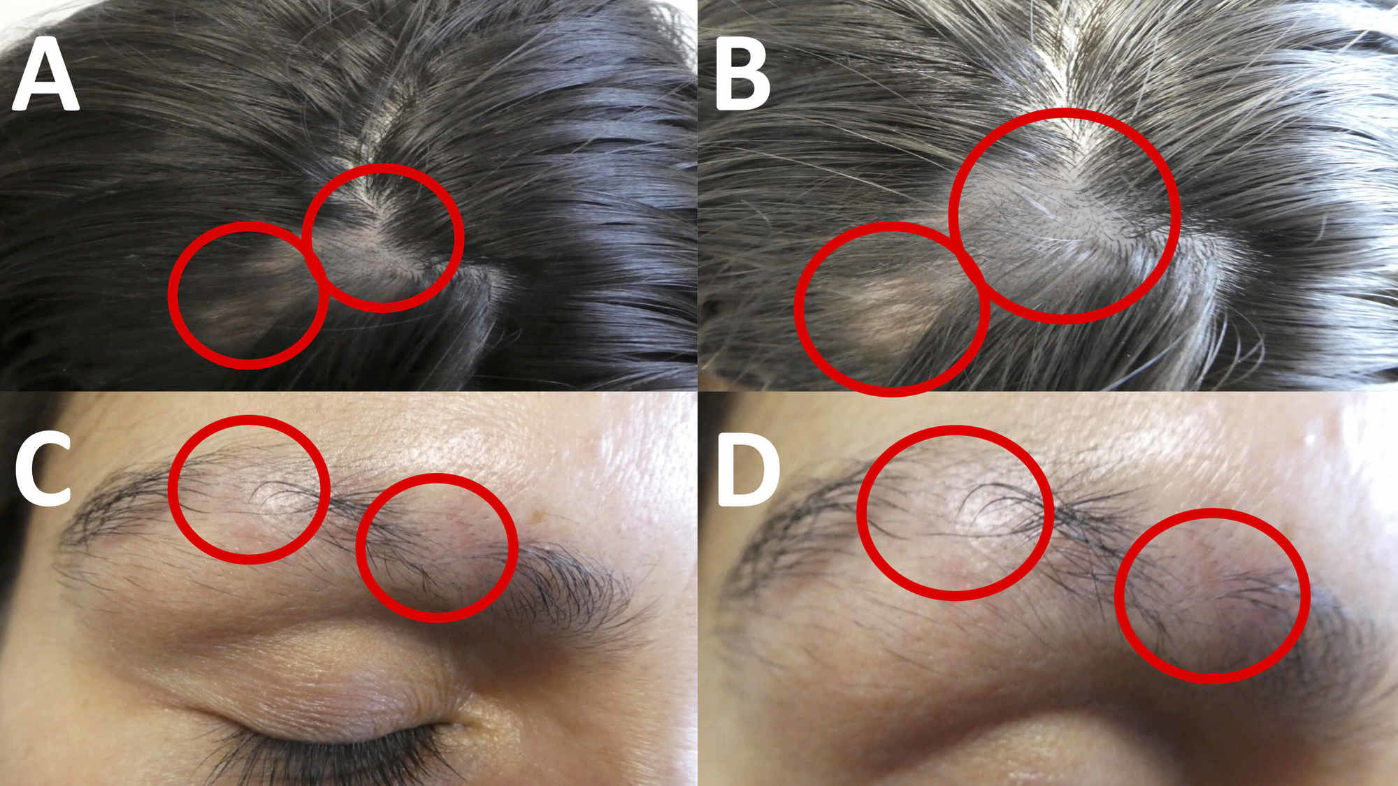Cureus | Systemic Lupus Erythematosus Presenting as Alopecia Areata |  Article