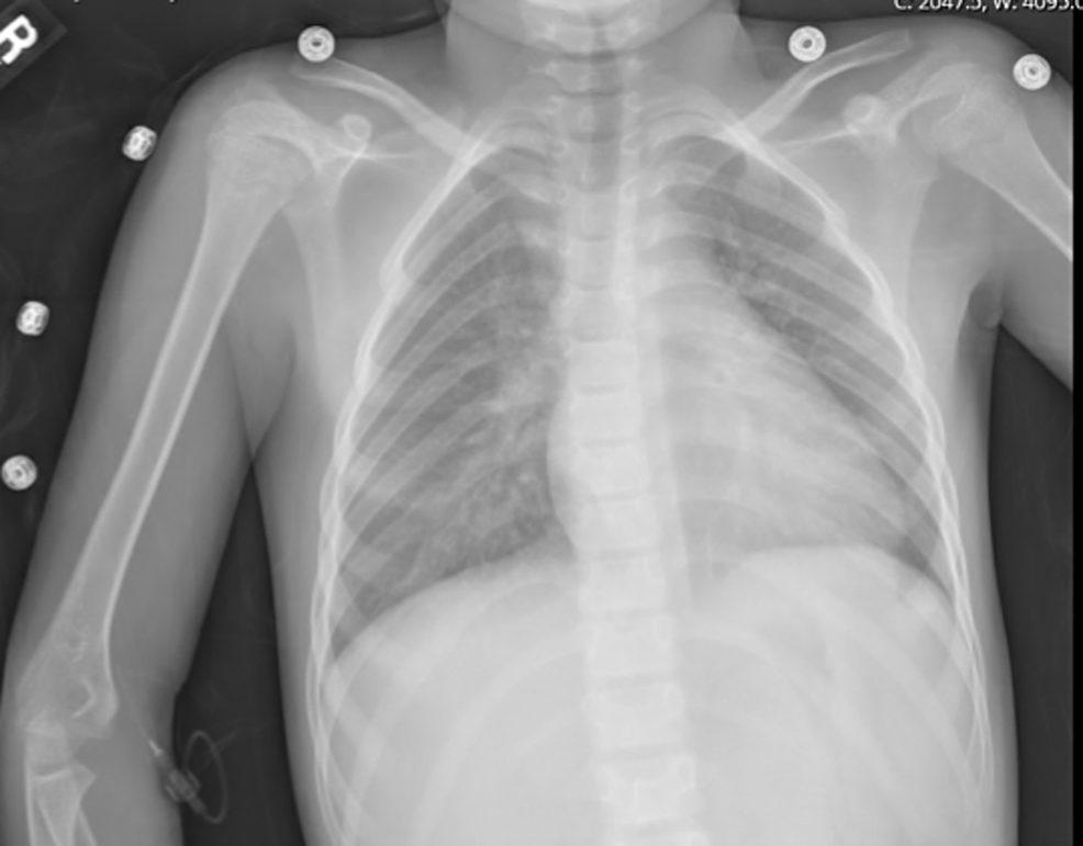 Pediatric Case of Severe COVID-19 With Shock and Multisystem ...