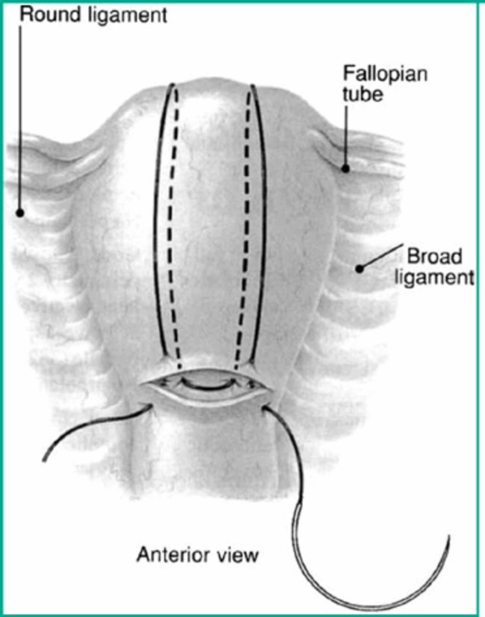 Cureus | Uterine Sandwich Method: A Case Of Posterior Placenta Previa ...