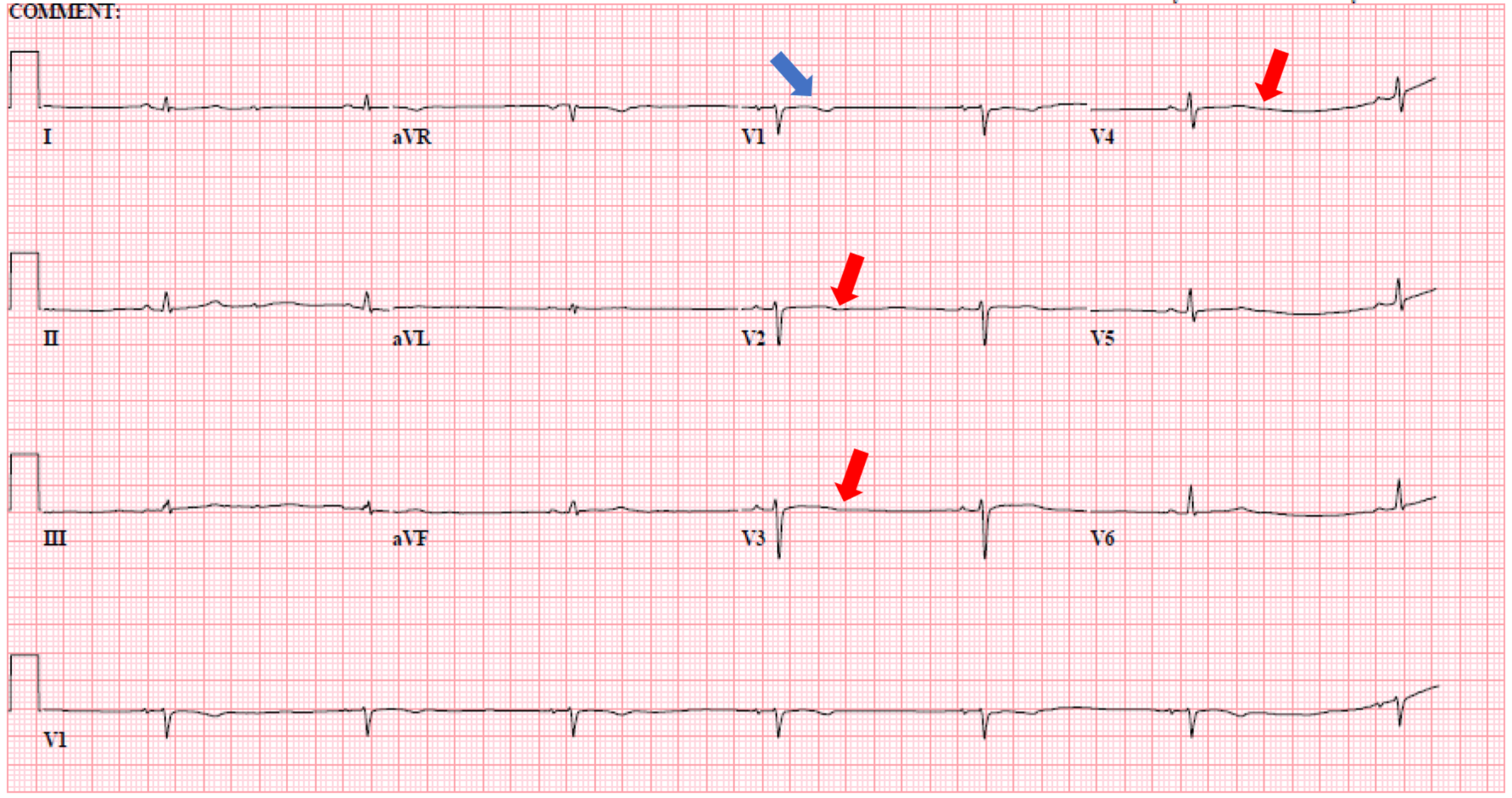 Cureus A Rare But Reversible Cause Of Lithium Induced Bradycardia