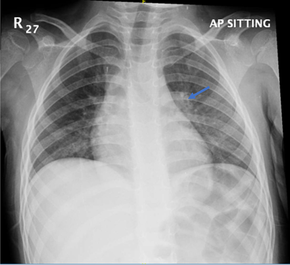 Cureus | Complicated Appendicitis in a Pediatric Patient With COVID-19 ...