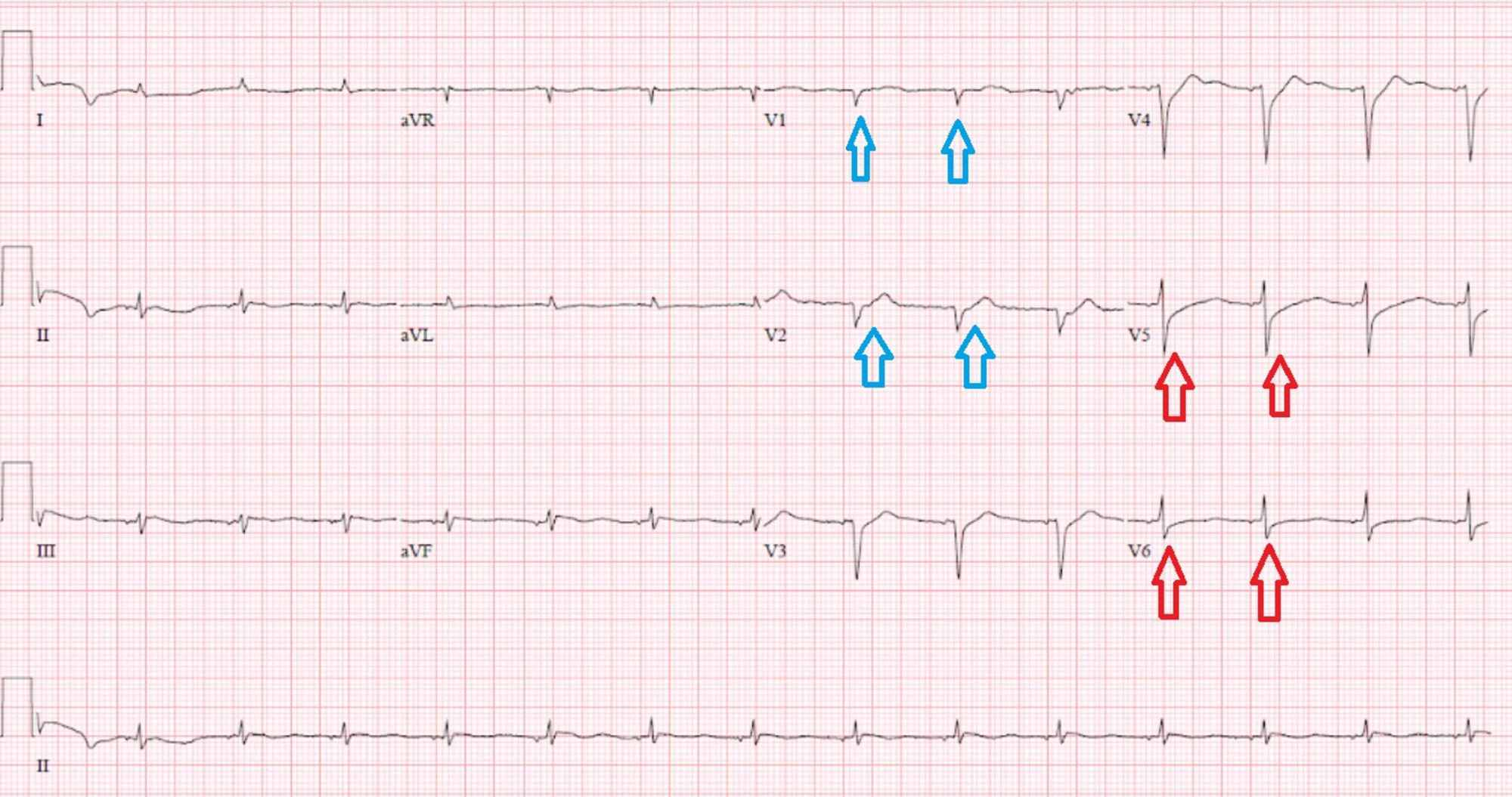 Cureus | An Atypical Presentation Of Fulminant Myocarditis Secondary To ...