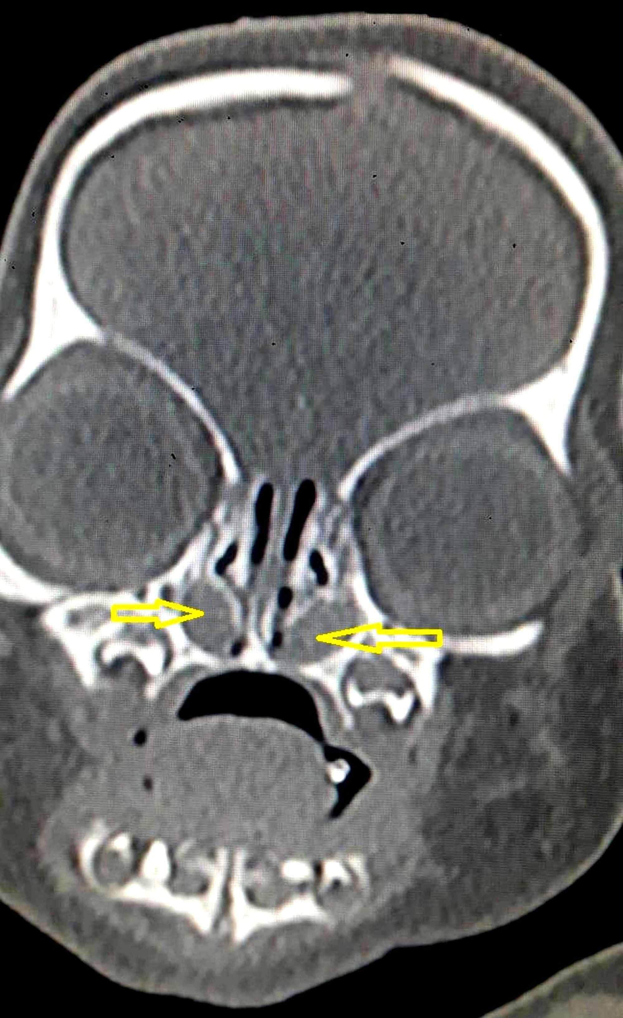 Cureus Bilateral Congenital Nasolacrimal Duct Cyst A Rare Cause Of My Xxx Hot Girl 