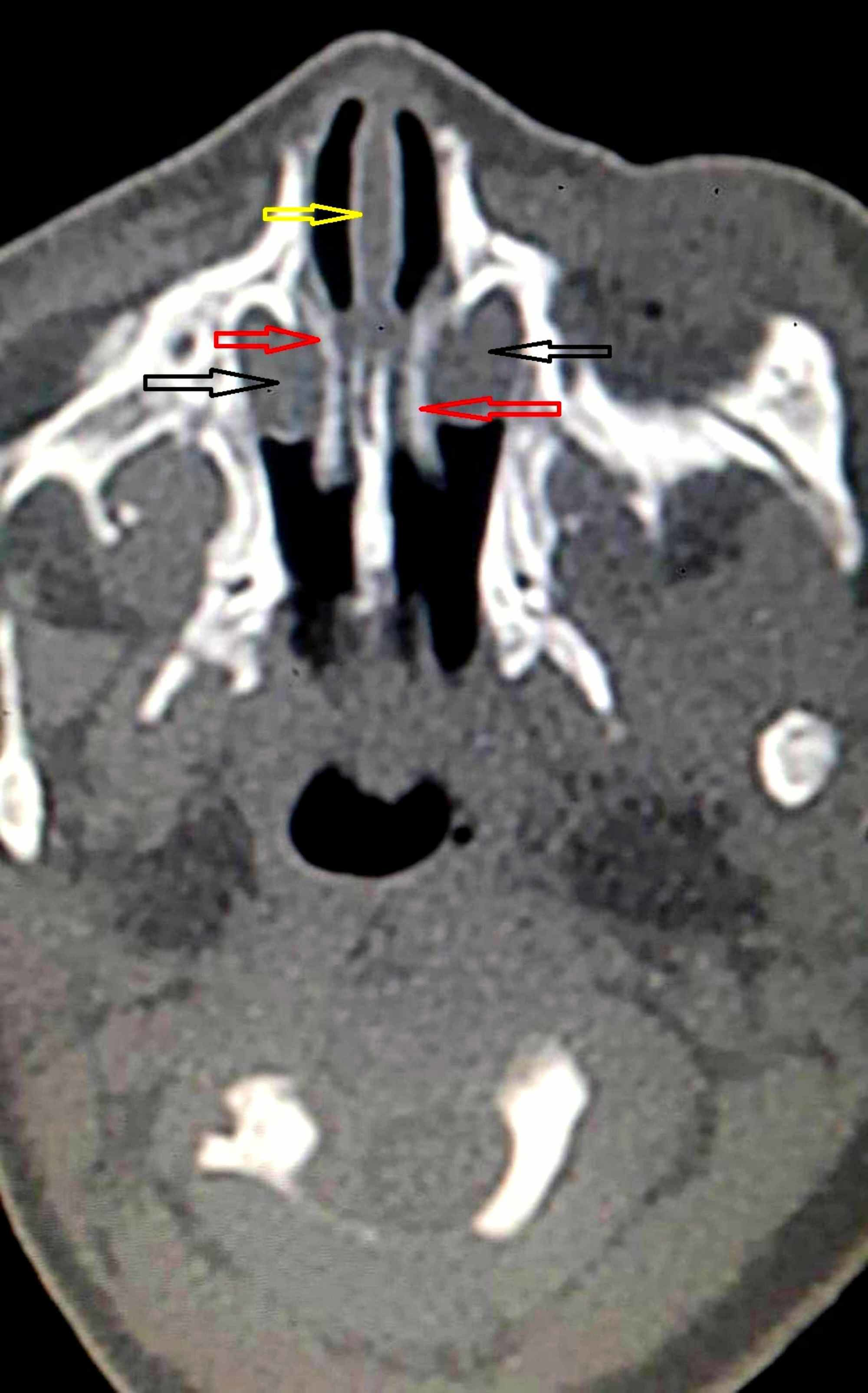 nasolacrimal cyst