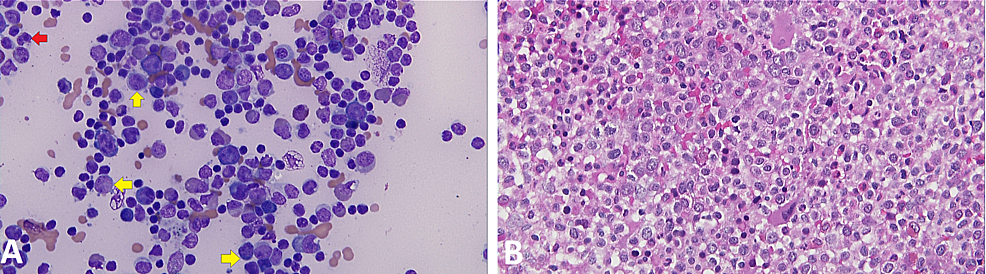 Cureus | A Rare Case of Leukemia Cutis as the First Presentation of a ...