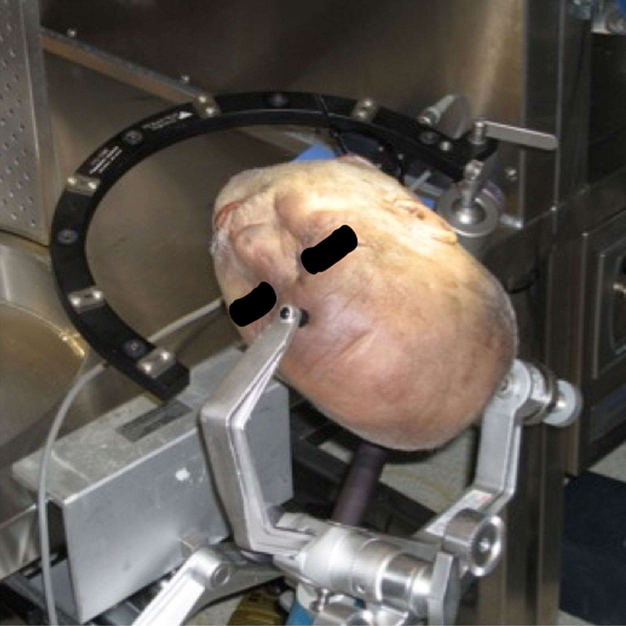 Cureus Transcavernous Approach to the Basilar Apex A Cadaveric