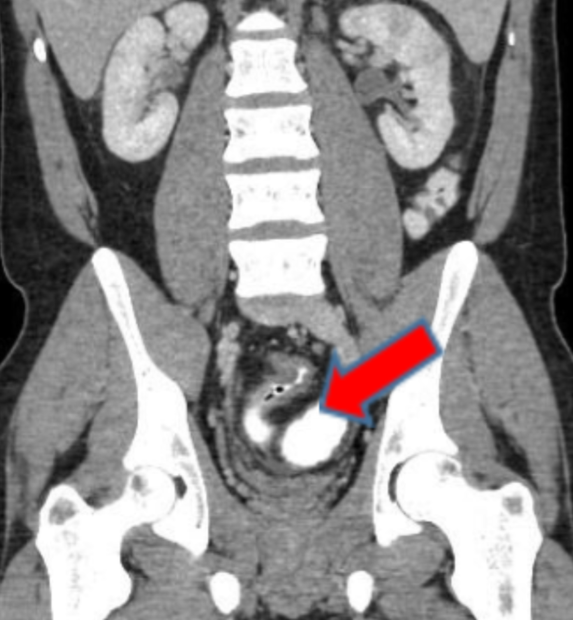 Cureus Recurrent Urinary Tract Infection in a Patient With
