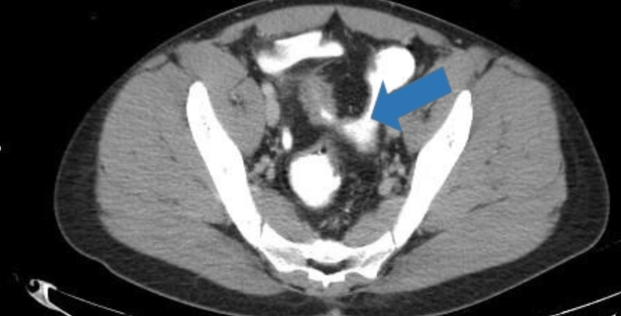 Cureus Recurrent Urinary Tract Infection in a Patient With