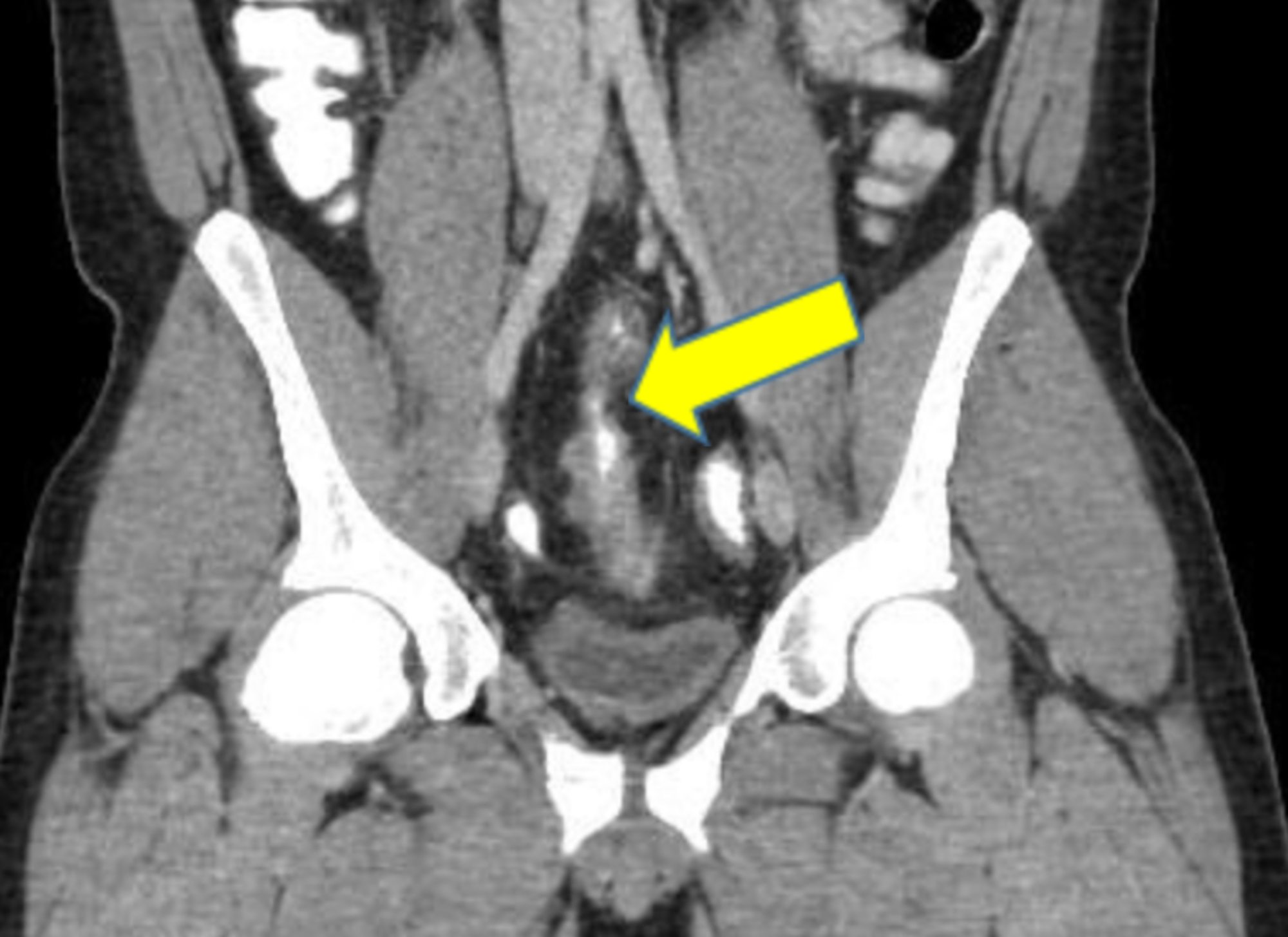 Cureus Recurrent Urinary Tract Infection in a Patient With